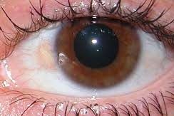 Pterigium