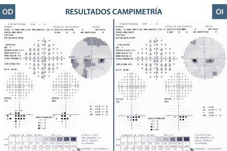 campimetría visual