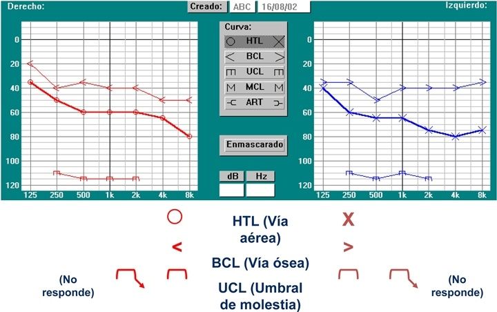 Audiometria Simbologia
