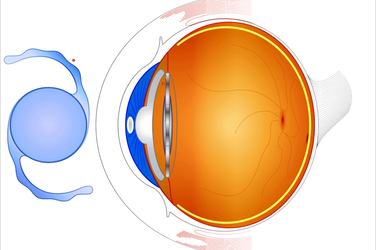 lentes trifocales