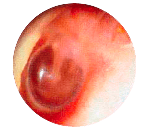 otoscopia