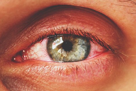 herpes ocular