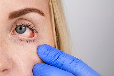 algo en el ojo