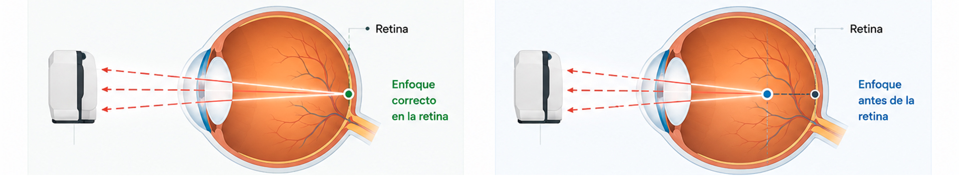 Cómo funciona la autorrefracción